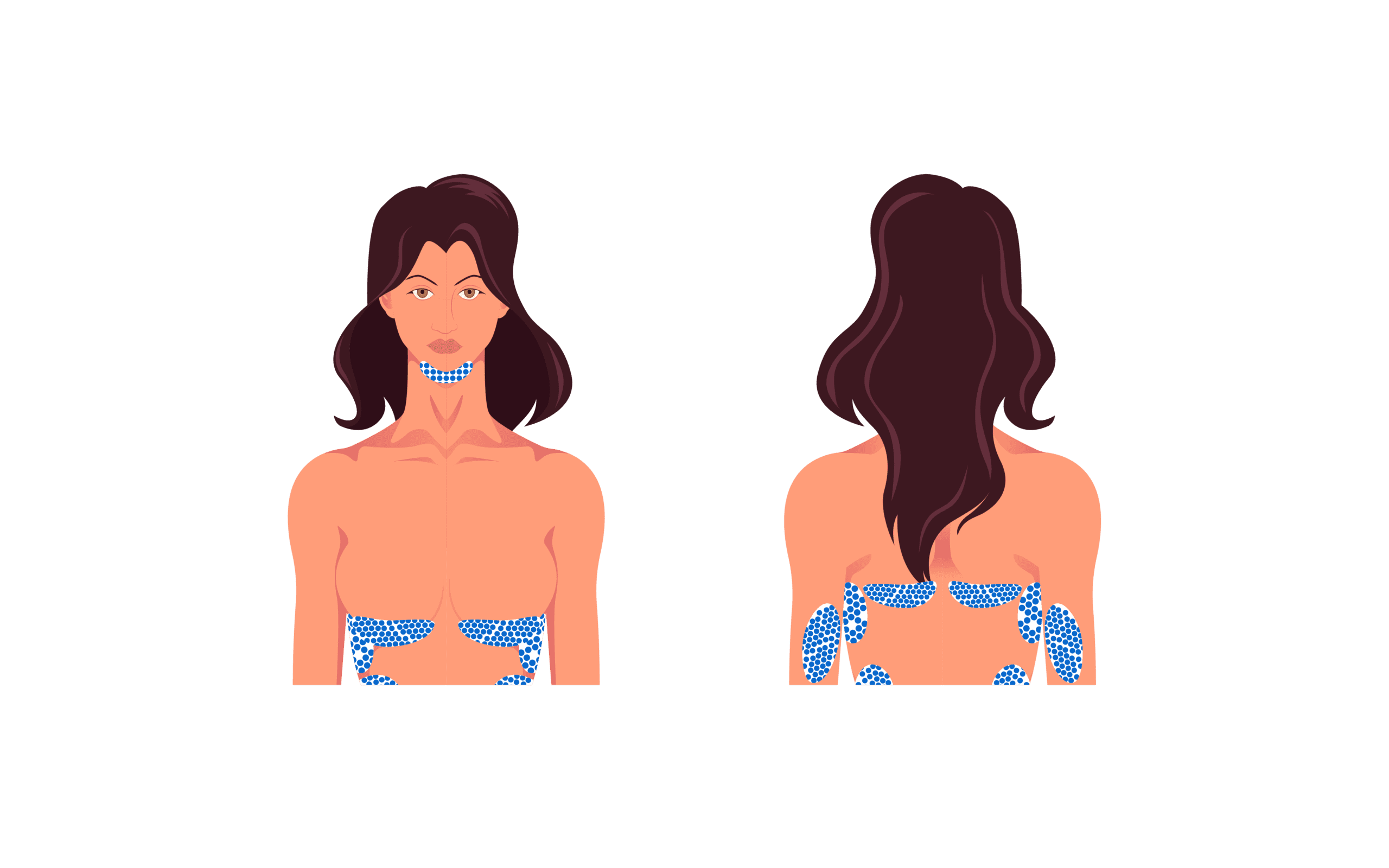 Woman getting CoolSculpting on the upper body