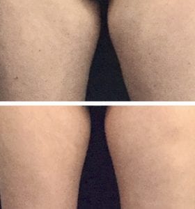 CoolSculpting Los Angeles before and after - leg