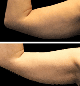 CoolSculpting Los Angeles before and after - arm