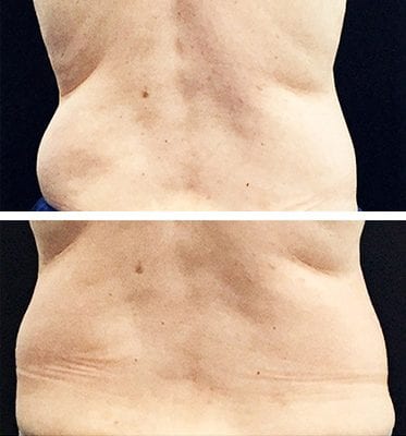 CoolSculpting Los Angeles before and after - back