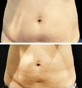 CoolSculpting Los Angeles before and after - stomach