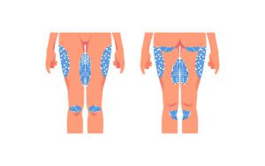 Person getting CoolSculpting for lower body