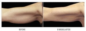 Arm