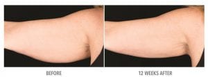 Arm