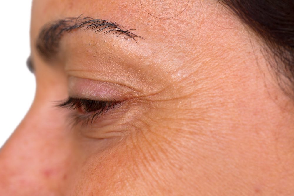 woman with crows feet who needs botox
