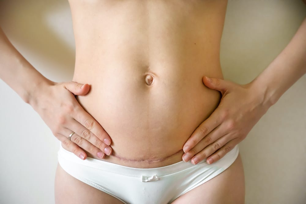 Can CoolSculpting Get Rid of My C-Section Pouch?