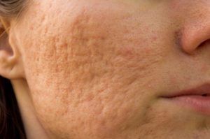 closeup image of woman's cheek with deep and painful acne scars