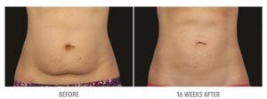 Abdomen