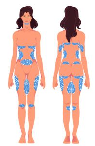 Woman with areas highlighted for CoolSculpting in Los Angeles