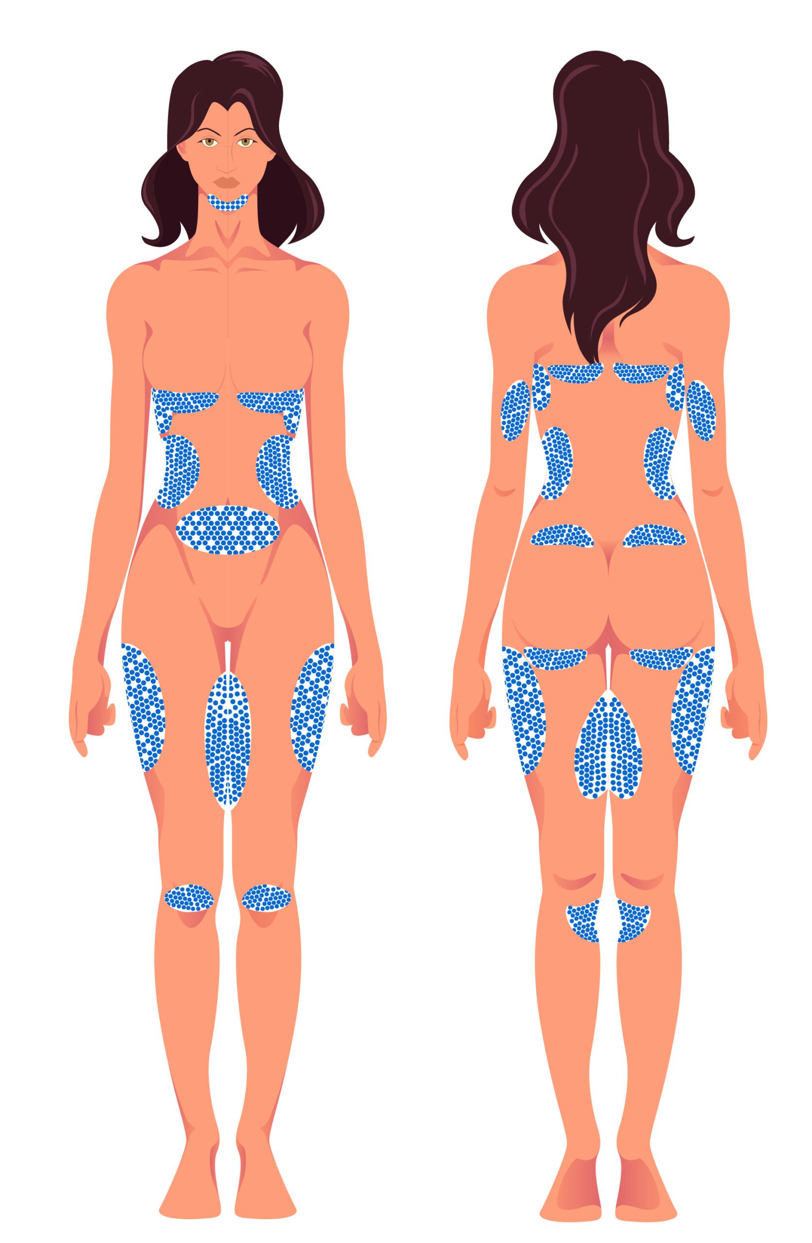 Woman with areas highlighted for CoolSculpting in Los Angeles