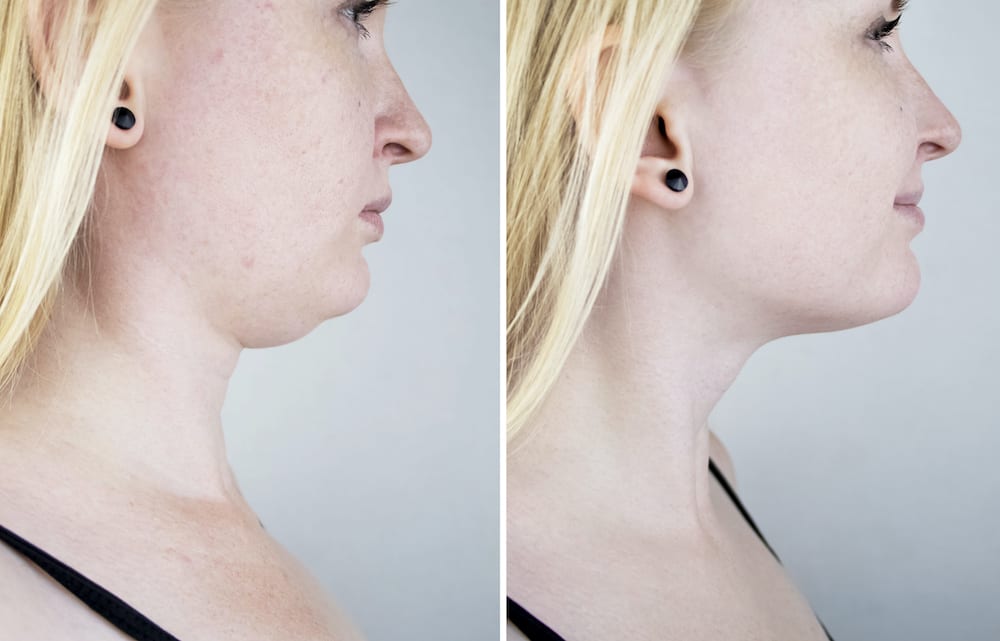 botox chin lift