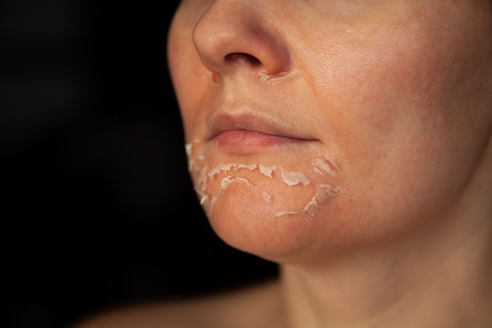 Woman's face after chemical peeling.