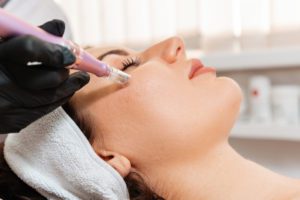 woman getting microneedling done at your laser skin care