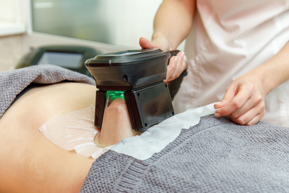woman getting coolsculpting done in los angeles after losing weight