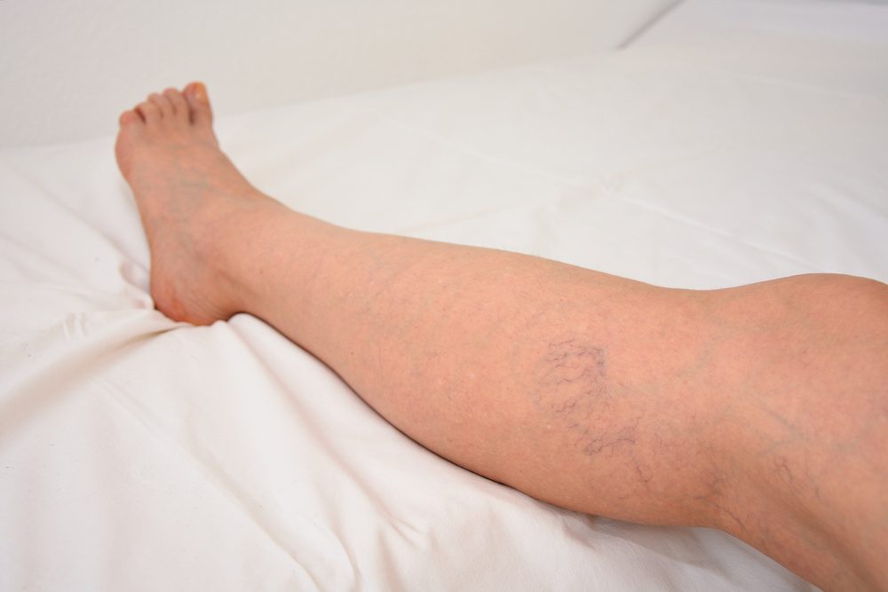 Varicose veins in female legs. The leg lies on a white sheet. Spider veins on upper calf