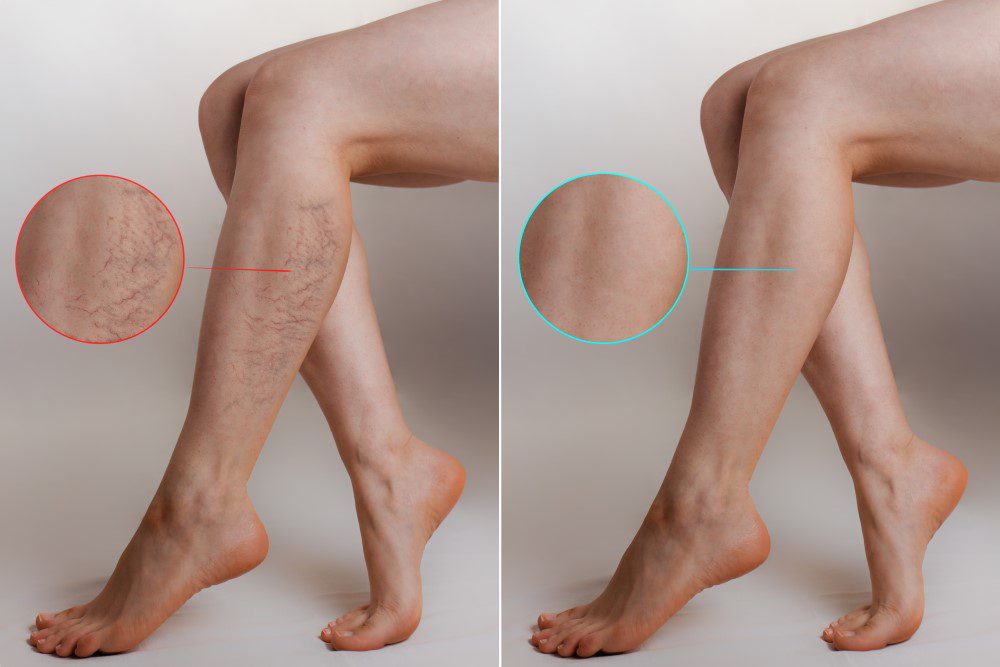 Before and after results of vein treatment therapy.