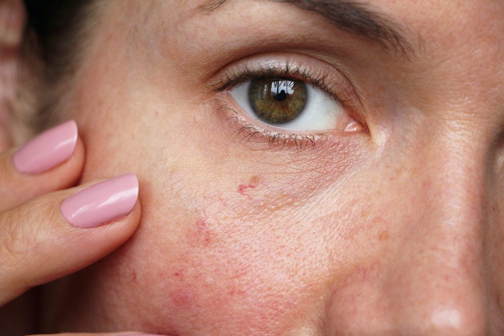 capillaries on the skin of the face, woman looking for laser therapy treatment