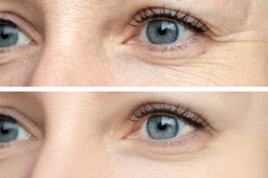 woman before and after a botox touch up session in los angeles